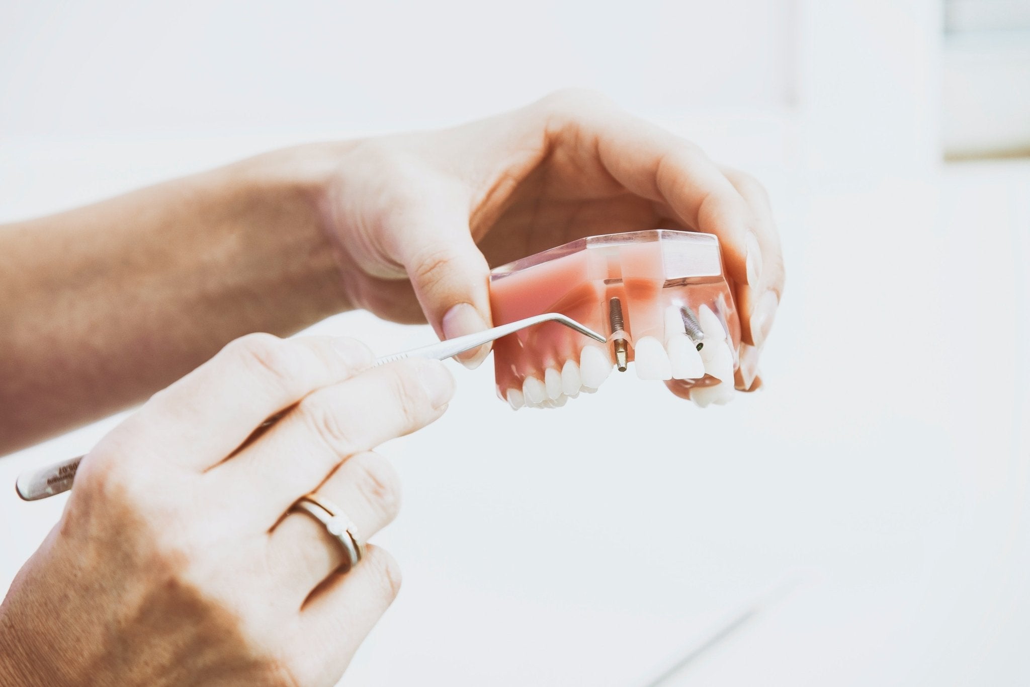 The Best Alternatives to Dentures (Are There Cheaper and Better Options?) - XODENT